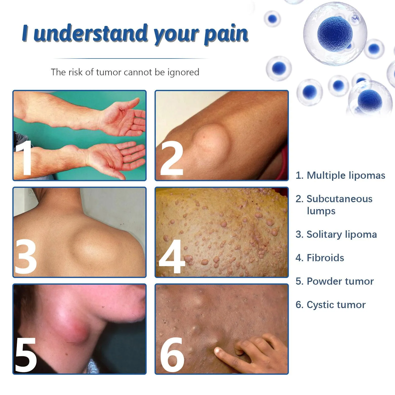 Types of Lipoma Tumors