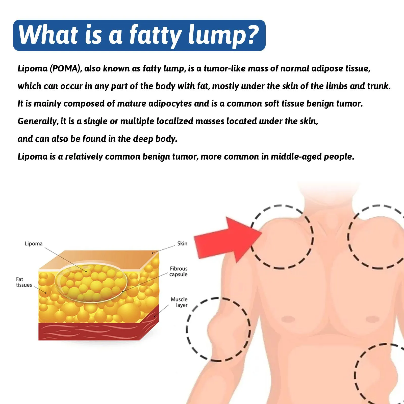 What is a fatty lump
